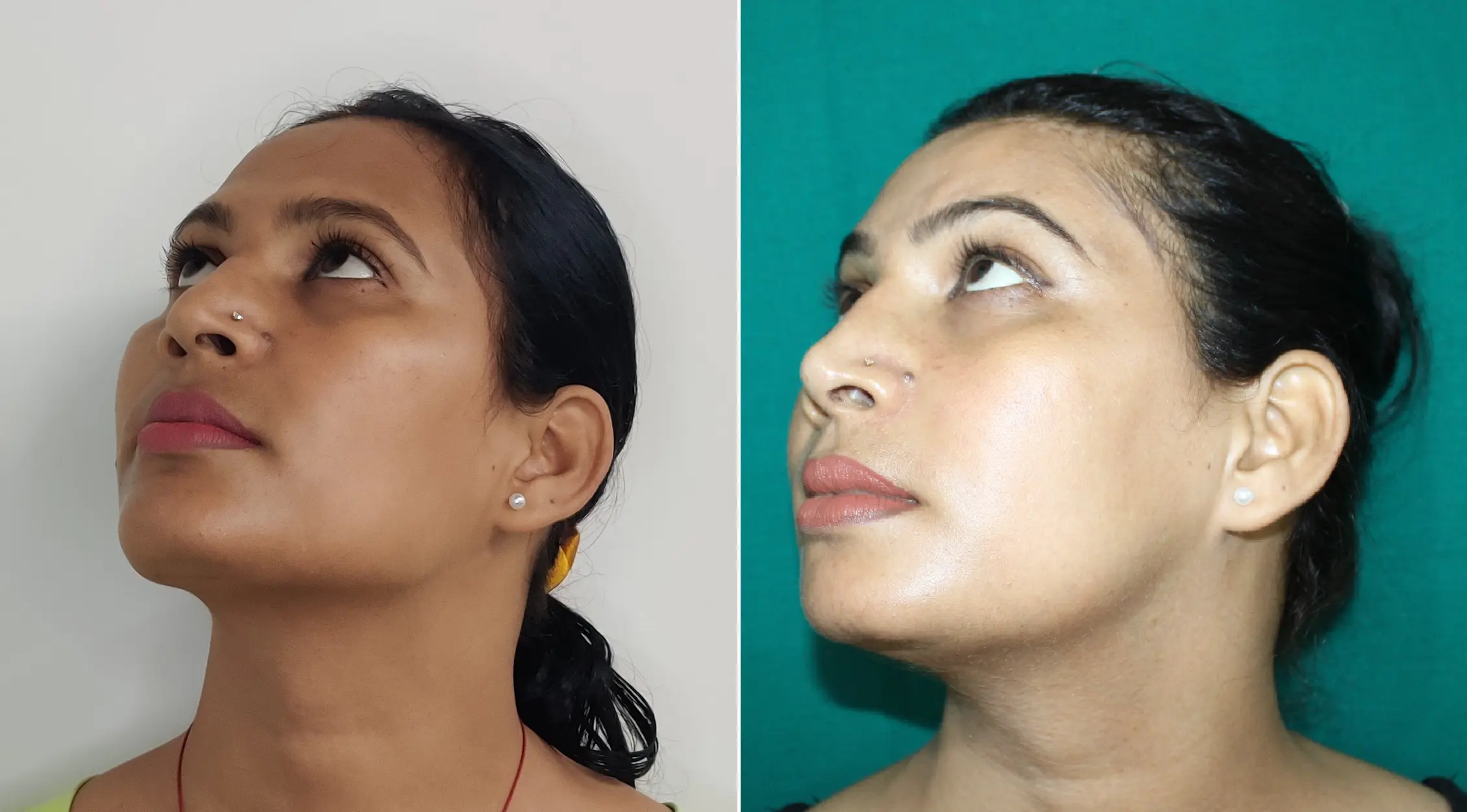 Gallery facial feminization after result